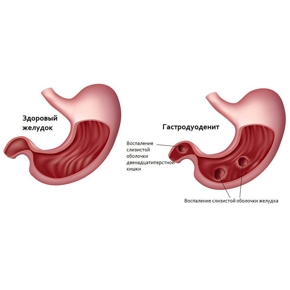 ХРОНИЧЕСКИЙ ГАСТРОДУОДЕНИТ