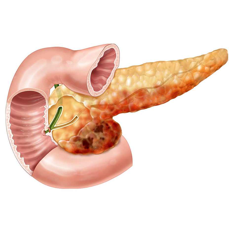 ХРОНИЧЕСКИЙ ПАНКРЕАТИТ