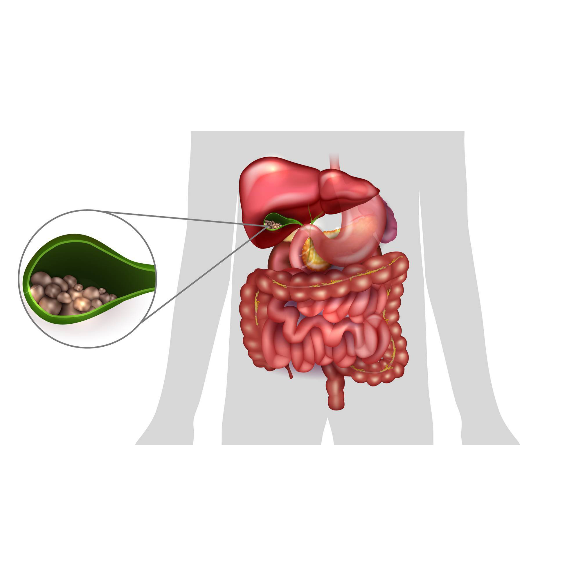 ХОЛЕЦИСТИТ И ЖЕЛЧЕКАМЕННАЯ БОЛЕЗНЬ