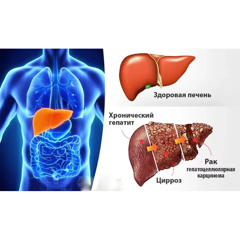 ХРОНИЧЕСКИЕ ГЕПАТИТЫ