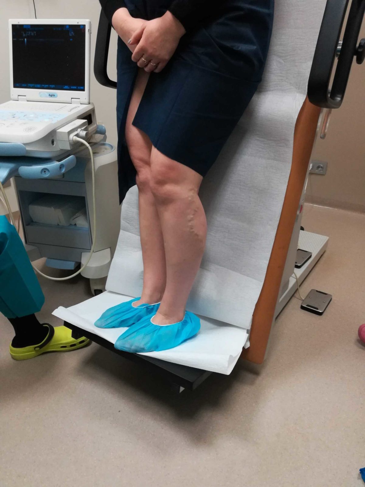 Виды лечения варикоза малого таза