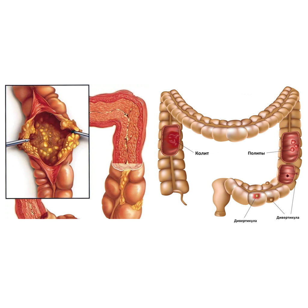 ЭНТЕРИТ И КОЛИТ
