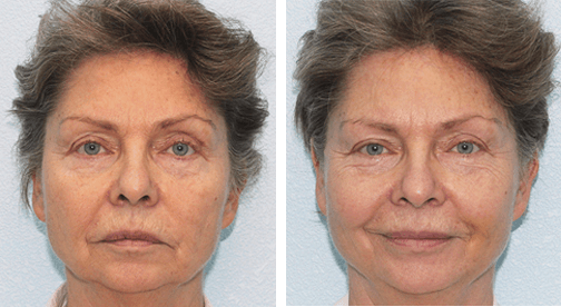 ЧТО ВЫ ПОЛУЧИТЕ В РЕЗУЛЬТАТЕ НИТЕВОГО ЛИФТИНГА?