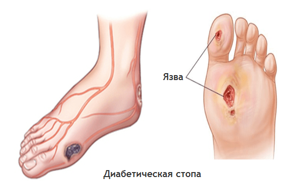 Диабетическая стопа