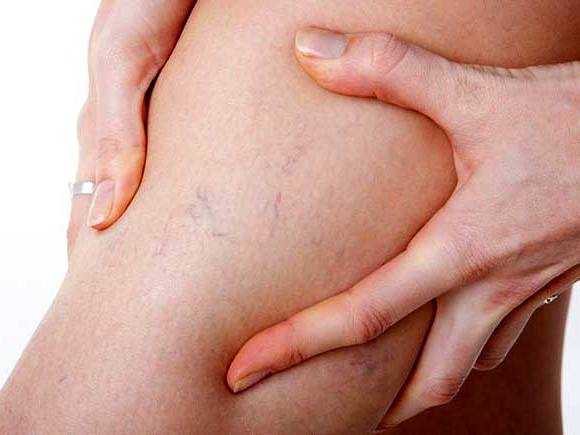 Симптомы варикоза