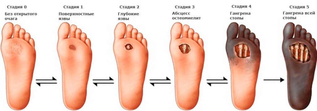 Диабетическая стопа: причины возникновения