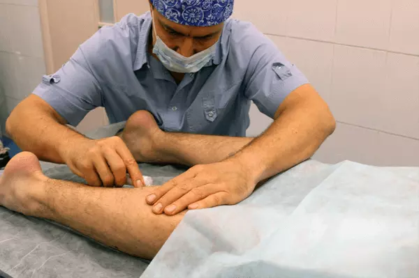 Варикоз и как его лечить