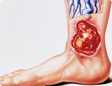 ЛЕЧЕНИЕ ТРОФИЧЕСКИХ ЯЗВ-примеры