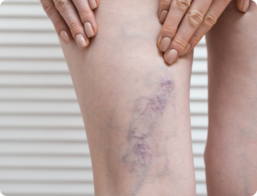 ЛЕЧЕНИЕ ВАРИКОЗА-примеры