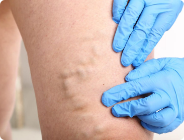 ЛЕЧЕНИЕ ВАРИКОЗА-примеры