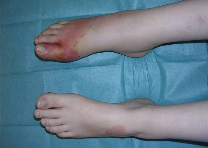 Синдром диабетической стопы