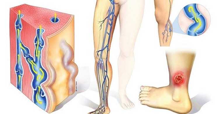 Трофические язвы