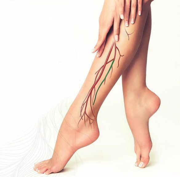 Консультация флеболога