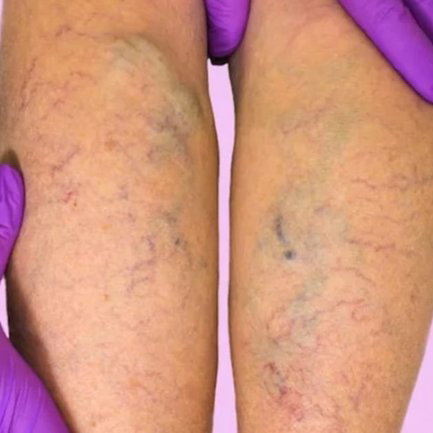 Варикозная болезнь нижних конечностей